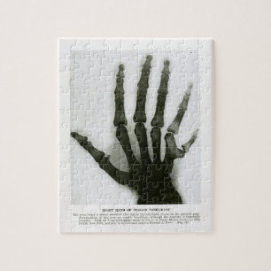Xray of Six Fingered Hand Puzzle